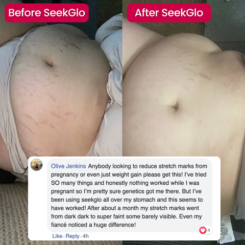SeekGlo Stretch Mark Serum