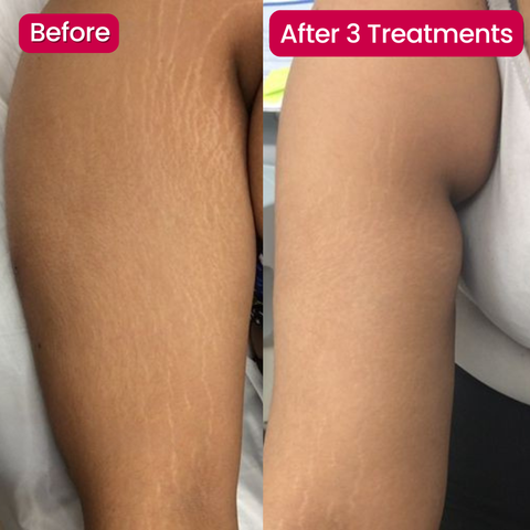 SeekGlo Stretch Mark Serum