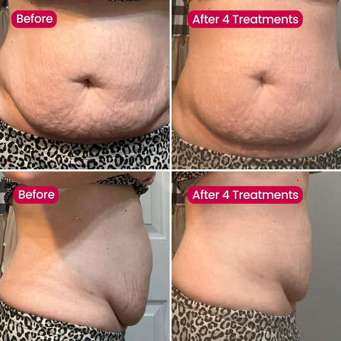 SeekGlo Stretch Mark Serum