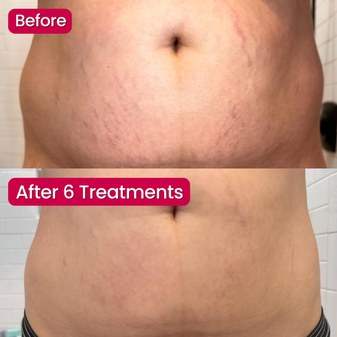 SeekGlo Stretch Mark Serum
