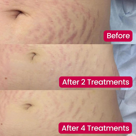 SeekGlo Stretch Mark Serum